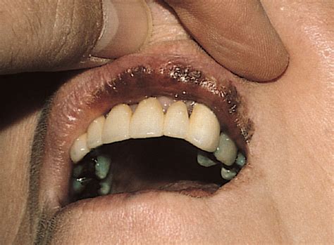 Lentigo Maligna With Spread Onto Oral Mucosa Dermatology Jama