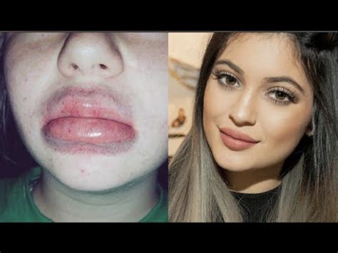 Kylie Jenner Lip Challenge Gone Wrong Kizziwalob