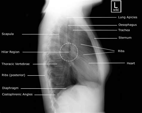 Each of the areas of the neck are located bilaterally and contain subdivisions which indicate the location of specific structures. Chest Image Analysis - Radiography Image Analysis I with ...
