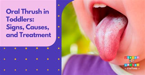 Oral Thrush In Toddlers Signs Causes And Treatment Junior Smiles