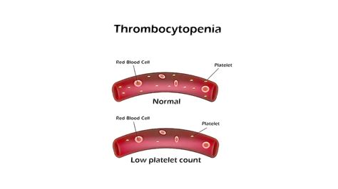What Is Immune Thrombocytopenia Storymd