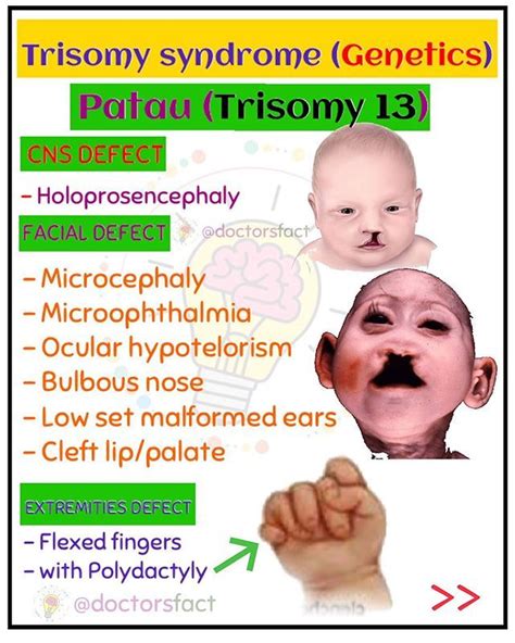 Patau Syndrome Trisomy 13 Defect What Is Patau Syndrome Patau