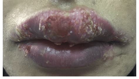 A Clinical Picture Of The Lips Showing Upper Lip Swelling Scattered