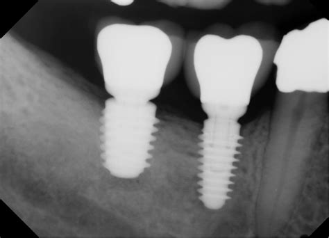 Tooth Implant X Ray Hot Sex Picture