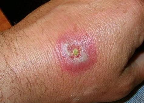 Hobo Spider Bite Symptoms Treatment And Stages