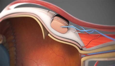 Retinal Detachment Surgery | ASG Eye Hospital