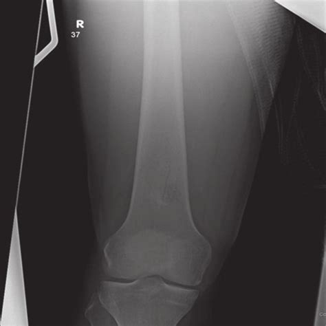 Radiograph Of Femurshows Breech In Distal One Third Of Femur In