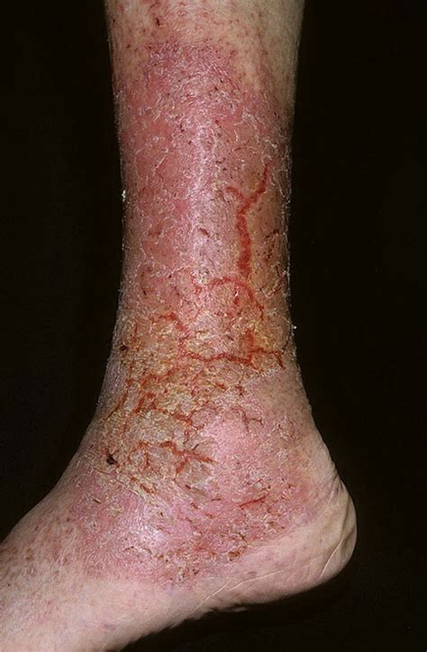 Venous Eczema On Legs Pictures 174 Photos And Images