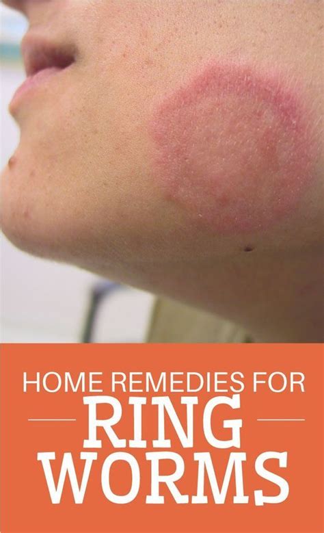 These Healing Home Remedies For Ringworm Are Natural While Over The