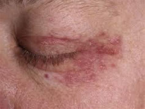 White Bump On The Eyelid Causes And Treatment 2020 Updated
