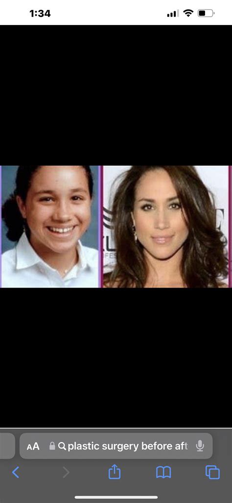 Bruce Jenner Another Victim Of Plastic Surgery Gone Wrong Dr Wigoda Pin