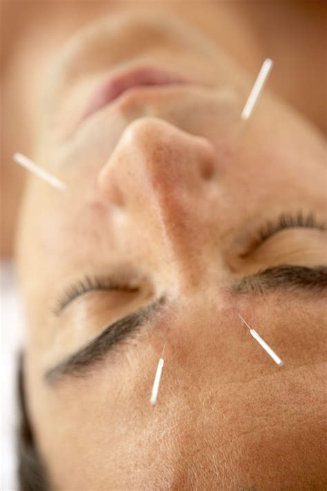 Can Acupuncture Treat Acne