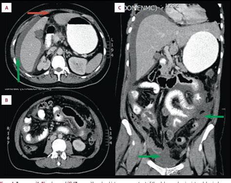 Figure 1 From Spontaneous Bacterial Peritonitis Due To Actinomyces