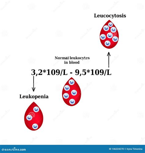 Conteggio Di Globulo Bianco Leucopenia Leucocitosi Infographics Illustrazione Di Vettore