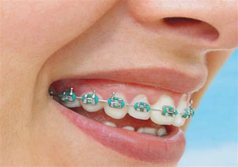 Brackets De Colores Clínica Dental En Valencia Benimaclet