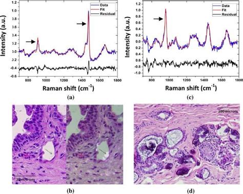 Typical Raman Spectra And Histopathology Of Breast Lesions Fibrocystic