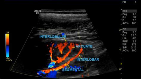 These give off a series of branches which enter the cortex as interlobular arterioles. Pin on Ultrasound pancreatic pic