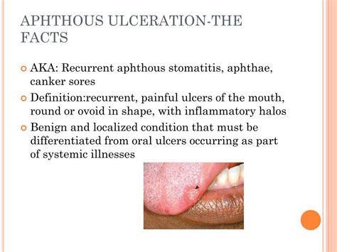 Ppt Aphthous Ulceration Powerpoint Presentation Free Download Id