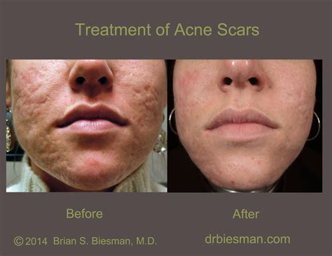 Acne Scars Plastic Surgery - Skin Care Tips
