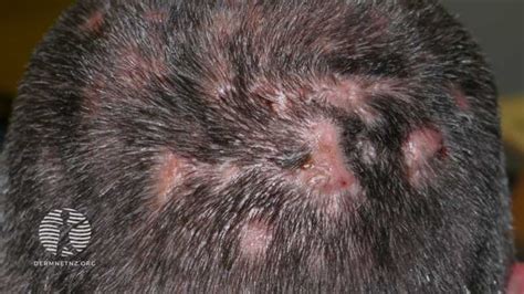 Case 3 Year History Of Scalp Lesions With Discharge — Dermnet