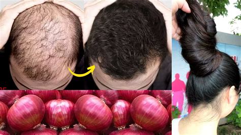 Onion For Hair Growth Diy Onion Hair Gel Grow Long And Strong Hair