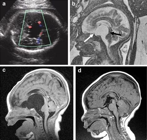 Suprasellar Arachnoid Cyst A Axial Image Of The Brain From Fetal