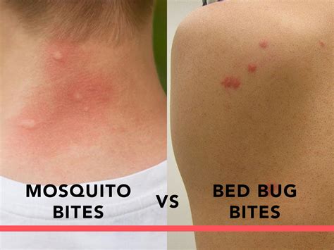 Mosquito Bites Vs Bed Bug Bites