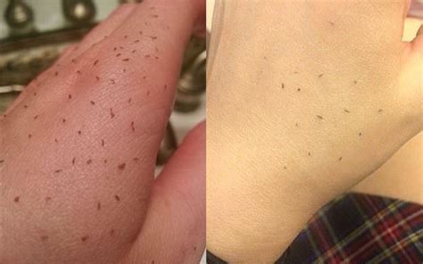 Skin Gritting Is Blackhead Removal Like Youve Never Seen Before