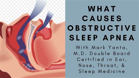 What Causes Obstructive Sleep Apnea Youtube