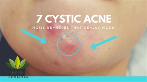 7 Cystic Acne Natural Remedies that Really Work - YouTube