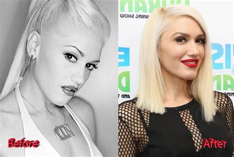 Gwen Stefani Plastic Surgery Baby Dont Lie Plastic Surgery Mistakes