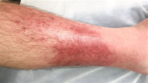 View 10 Brown Skin Lesions On Legs Leasnuesz