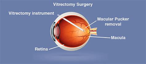 My retina had detached in 2003, and after operation i can see with this eye. Vitrectomy for retinal disorders