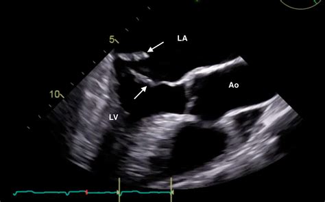 Cureus Emergent Diagnosis Of A Flail Mitral Leaflet With Bedside Echocardiography