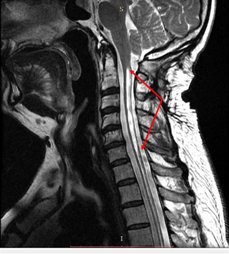 Sagittal Mri C Spine T2 With Structures Labeled Mri Mri Study Images