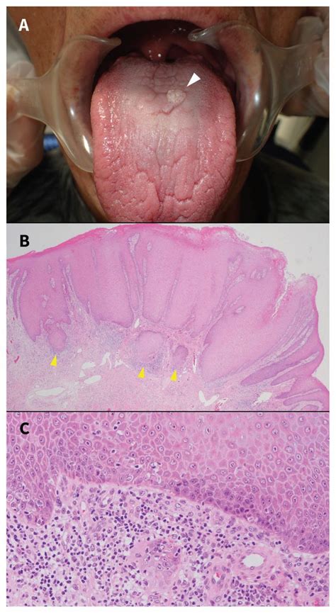 Squamous Cell Carcinoma Of The Dorsal Tongue Cmaj