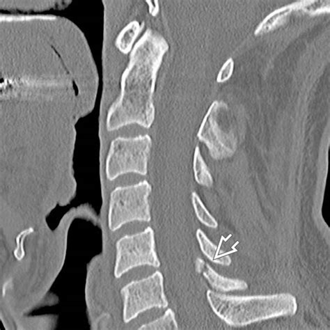Cervical Hyperextension-Rotation Injury | Radiology Key