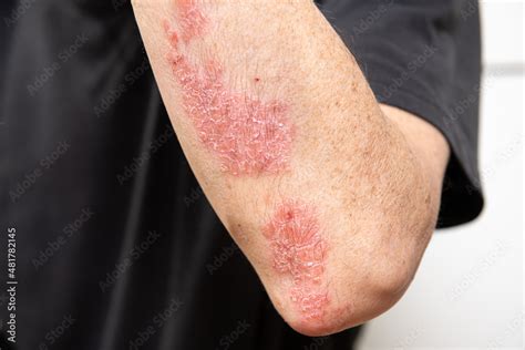 Acute Psoriasis On Elbows Knee Is An Autoimmune Incurable
