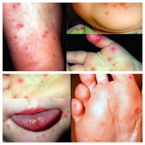 Tanda hiv yang sering dialami adalah masalah kulit. Lini Khalil: PENYAKIT KUKU KAKI TANGAN DAN MULUT.