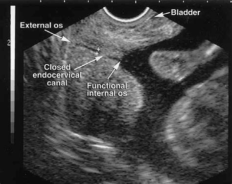 Pdf What We Have Learned About Cervical Ultrasound Semantic Scholar