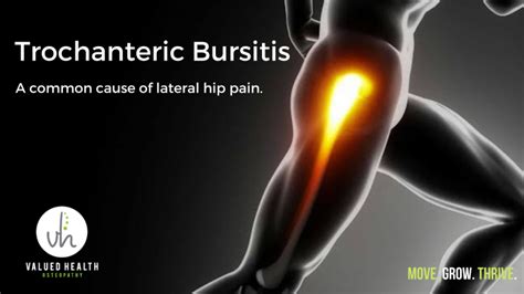 Trochanteric Bursitis A Common Cause Of Lateral Hip Pain