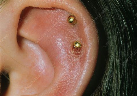 Ear Pinna Infection Due To Wearing An Earring Stock Image M1570043
