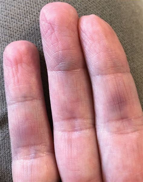 Identifying A Painful Bump On Finger Pad Thriftyfun