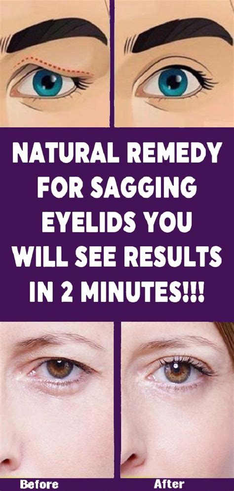 Get Rid Of Sagging Eyelids Natural Therapy Natural Remedies