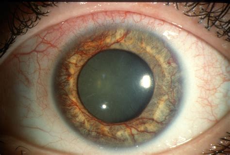 Moran Core Neovascularization Of The Iris Rubeosis Iridis