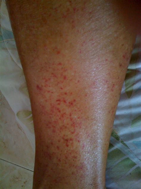 Can Leggings Cause Rash On Legs And Arms