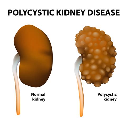 Treatment For Kidney Disease How To Treat Polycystic Kidney Disease