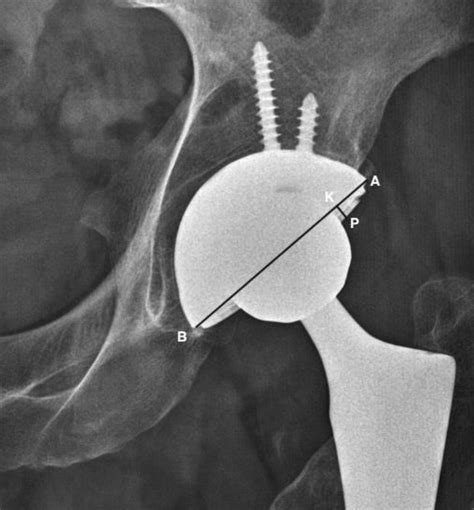 Acetabular Anteversion Measurement Sample On Ap Hip X Ray Of Patient