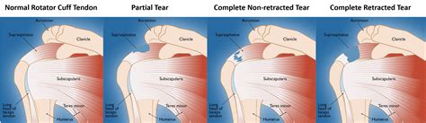 Rotator Cuff Surgery How To Avoid It Nashville Regenerative Orthopedics