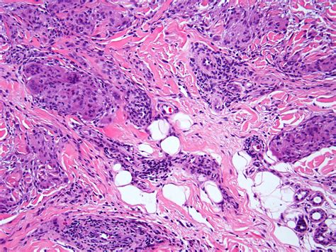 Pathology Outlines Granuloma Annulare